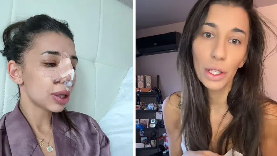 Виктория скоро ще покаже резултата след ринопластиката.